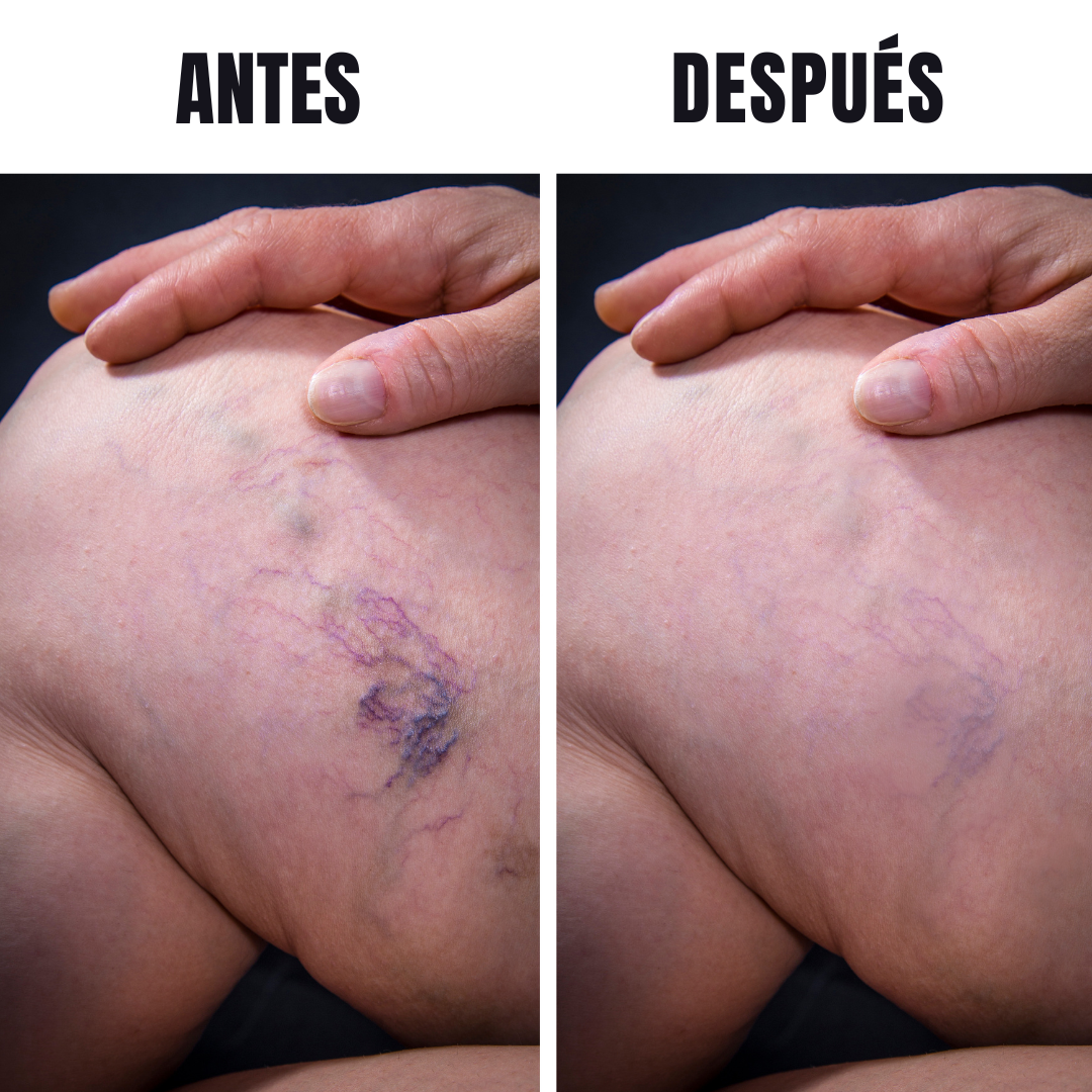 Variless 30 Cápsulas – Complemento alimenticio que ayuda a mejorar la circulación de las piernas