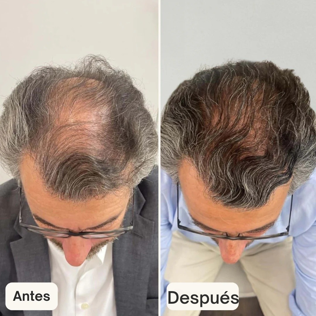 Suero anticaída para el cabello - HAIR BIOLABS 60 ml (OFERTA 2X1)